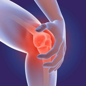 Arthritis - Flexsion Ortho
