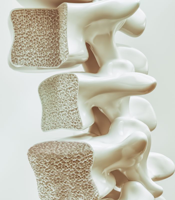 Osteoporosis - SBJ Ortho