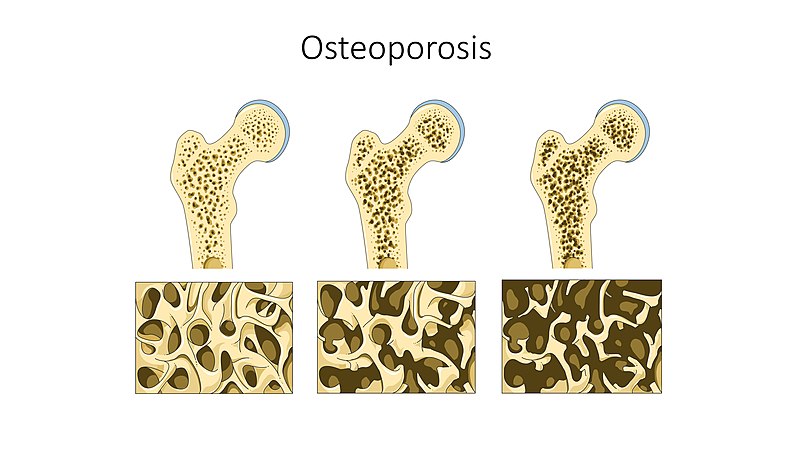 Osteoporosis Treatment Chennai - Shri Bone & Joint Clinic