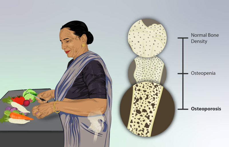 Depiction of an Osteoporosis patient - Shri Bone & Joint Clinic Chennai