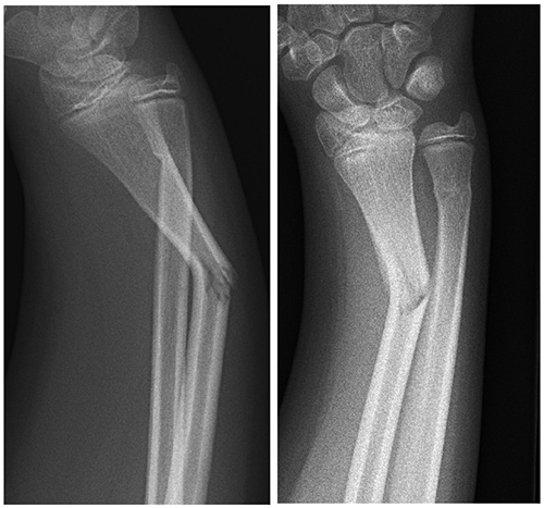 Leg Bone Fracture Collage - Shri Bone & Joint Clinic