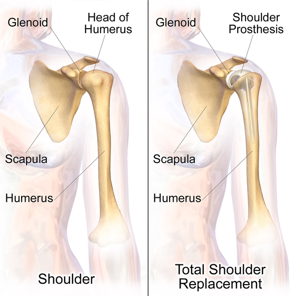 Total Shoulder Replacement / Arthroplasty
