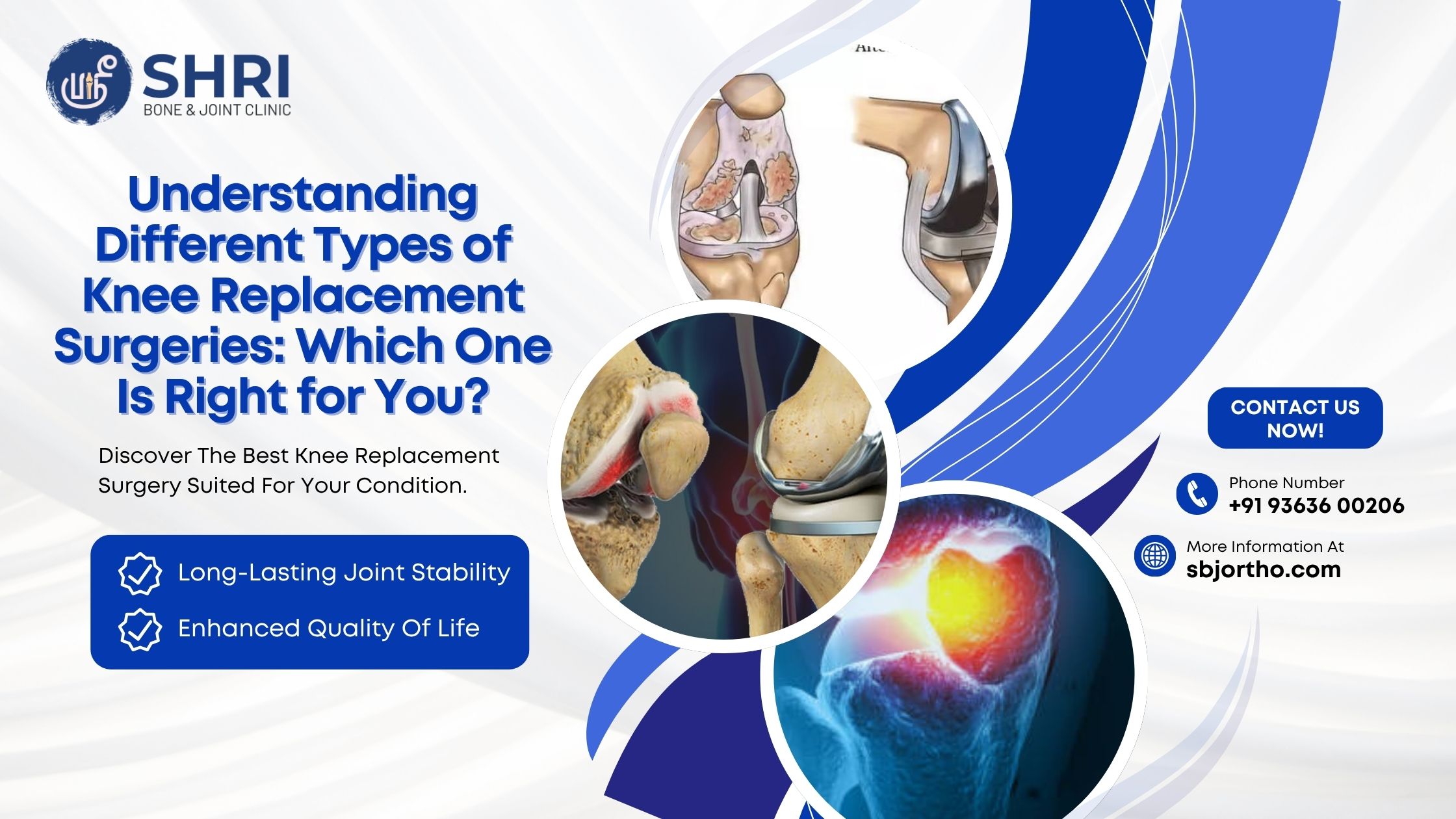 Understanding Different Types of Knee Replacement Surgeries: Which One Is Right for You?