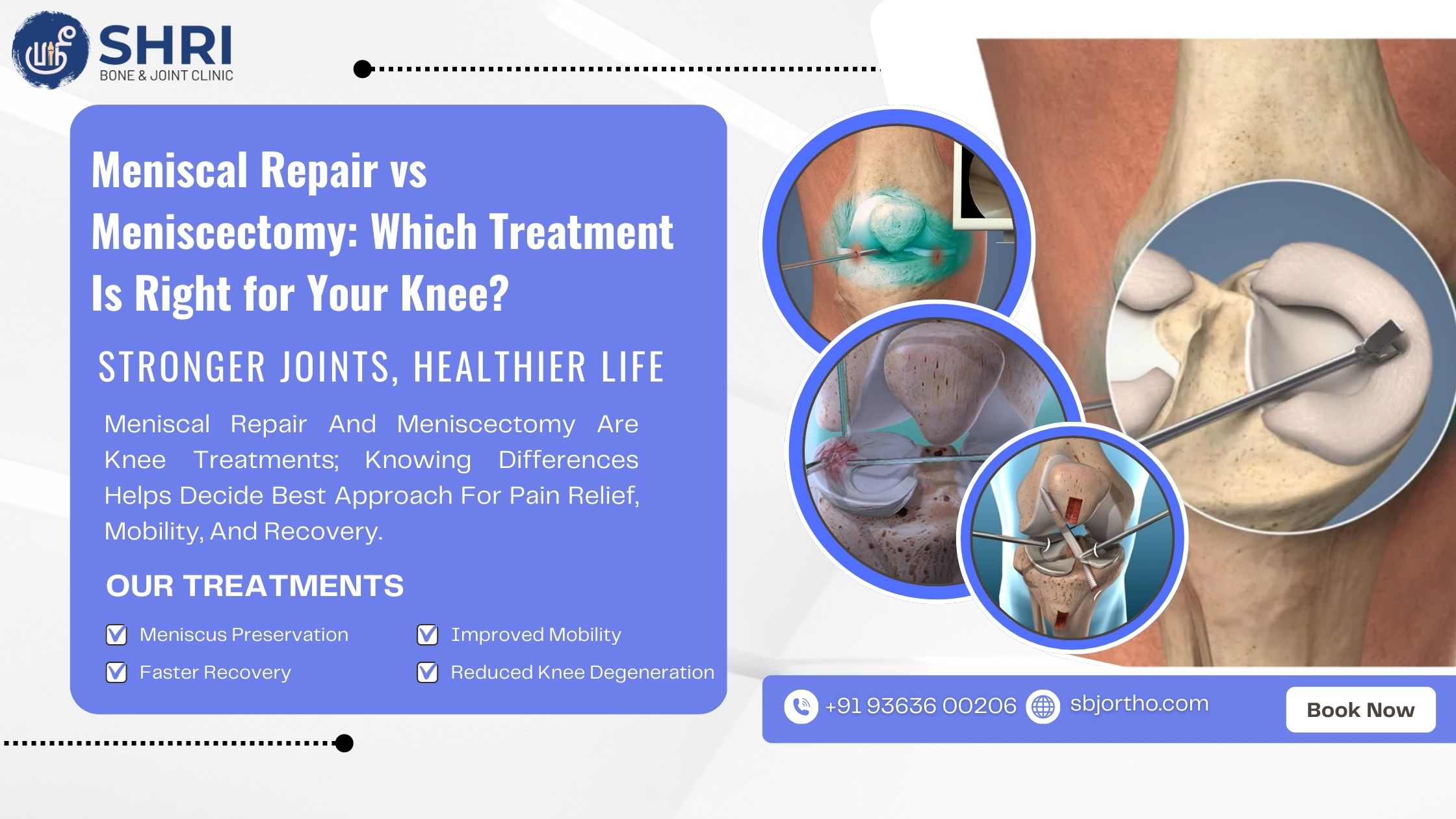 Meniscal Repair vs Meniscectomy: Which Treatment Is Right for Your Knee?