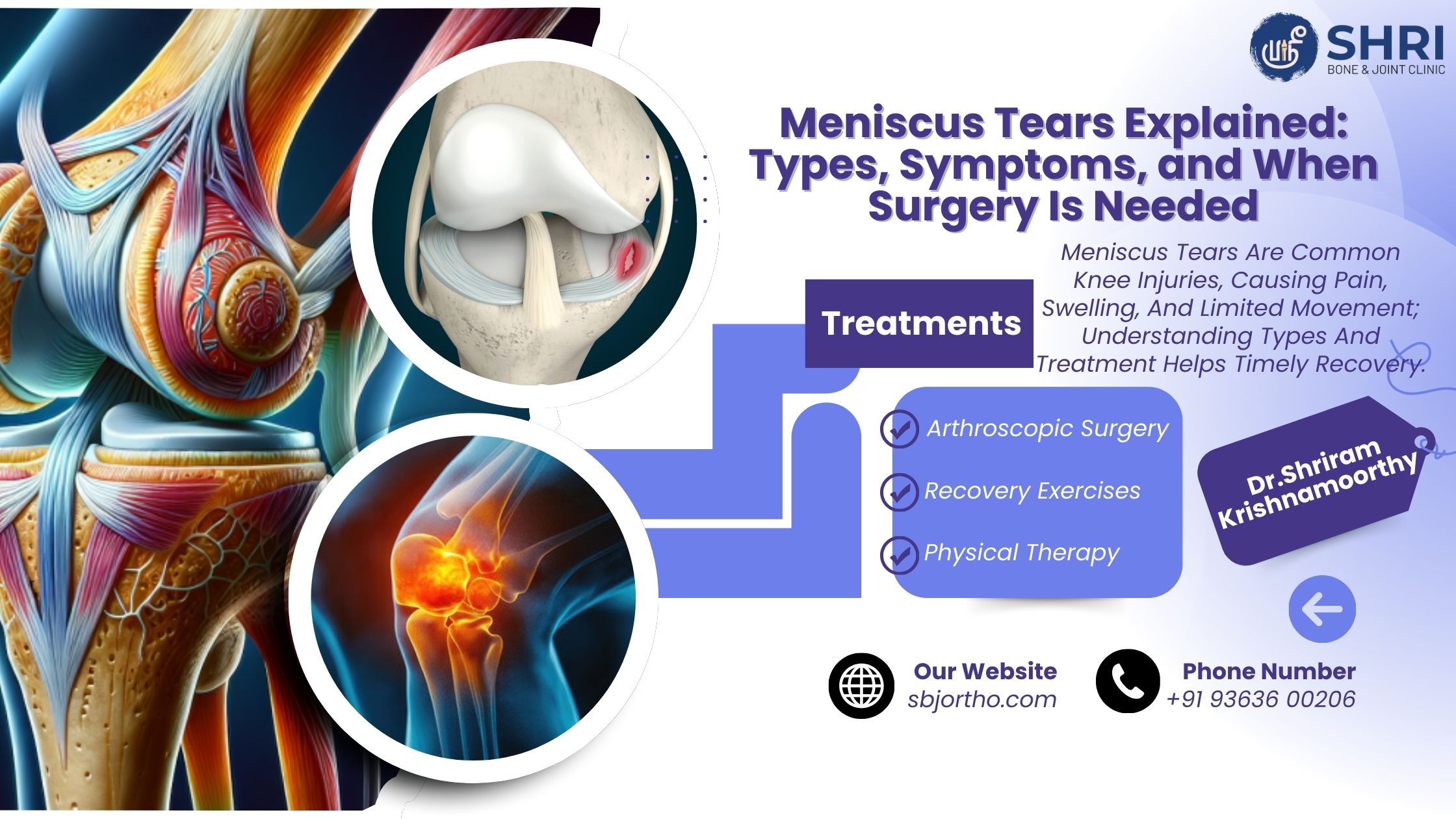 Meniscus Tears Explained: Types, Symptoms, and When Surgery Is Needed