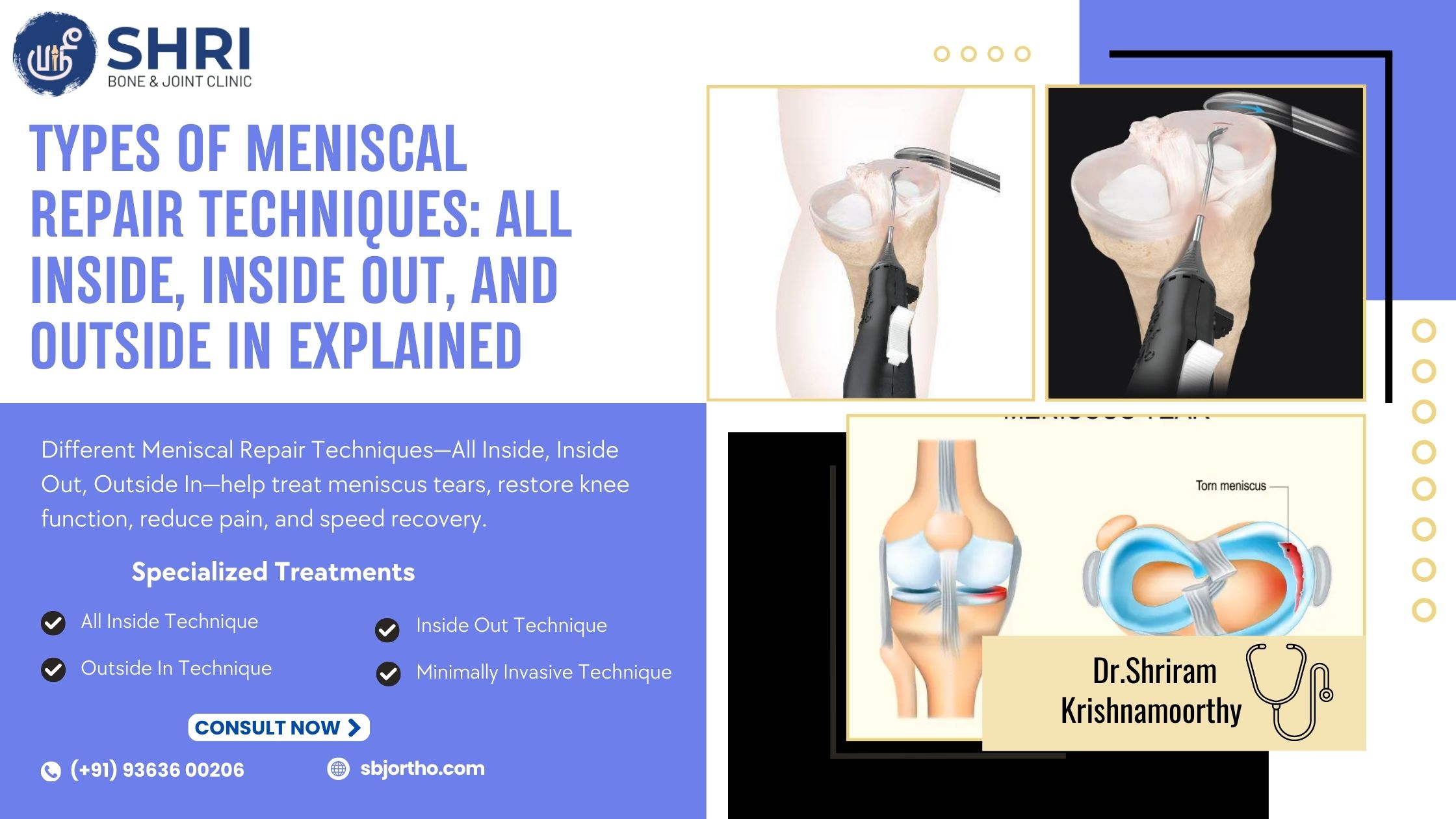 Types of Meniscal Repair Techniques: All Inside, Inside Out, and Outside In Explained